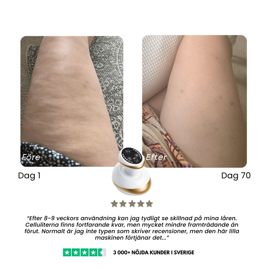 CelluSmooth™ – Cellulit massageapparat